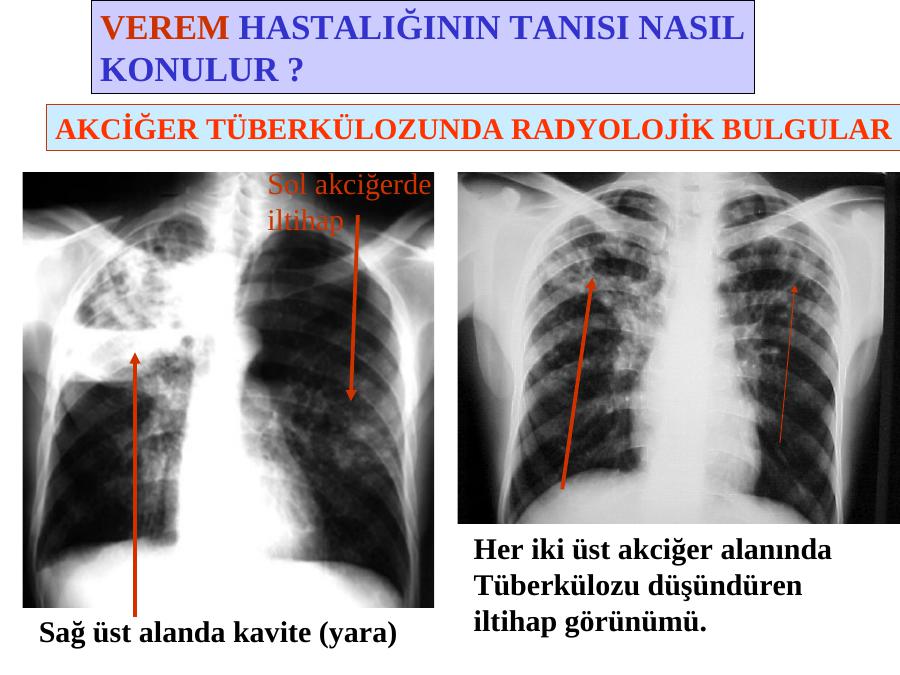 akciğer tüberkülozu kavitesi