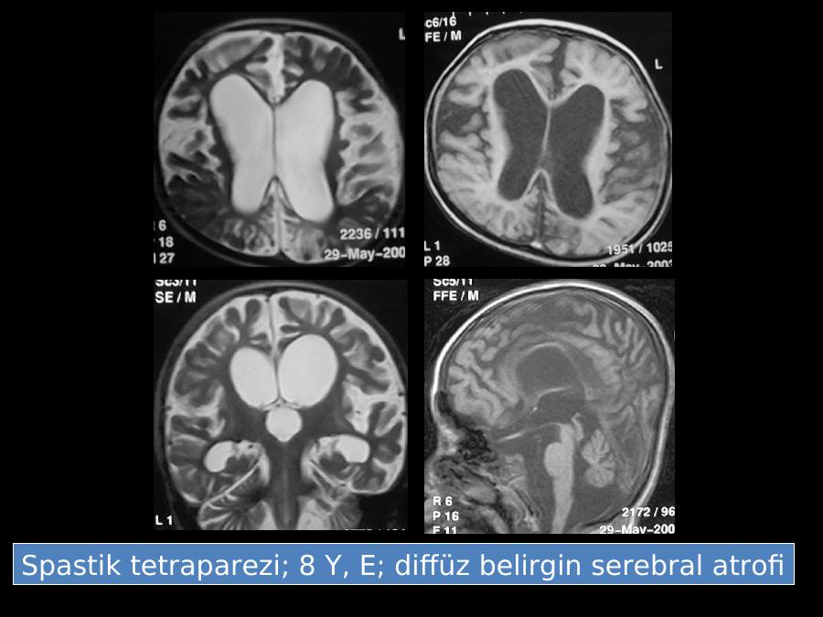 Serebral atrofi ve serebral beyaz cevherde kronik iskemik değişiklikler
