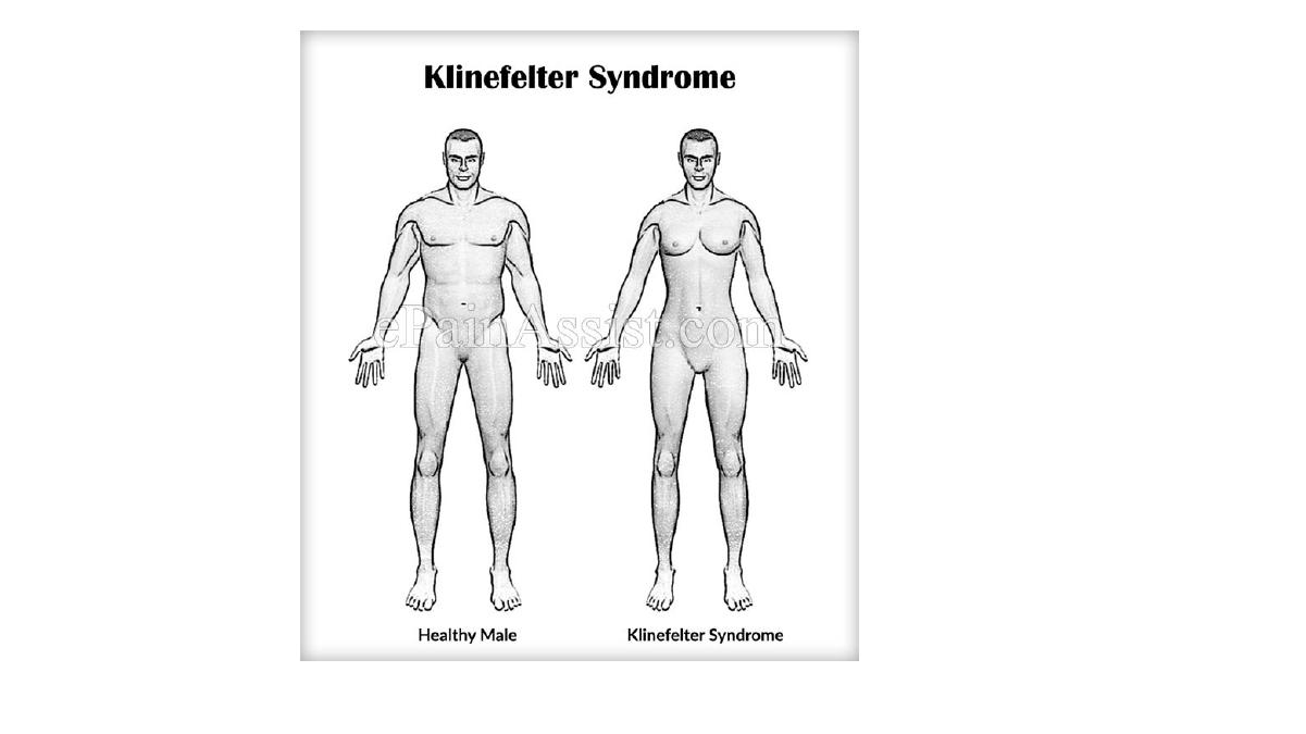Синдром клайнфельтера картинки
